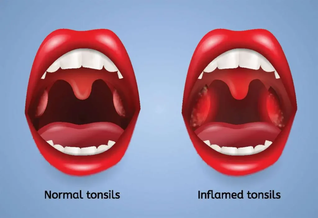Can Tonsils Grow Back After Being Removed? – tymoff
